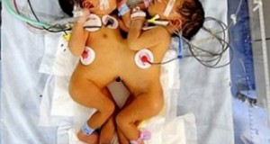 Швейцарські лікарі успішно розділили сіамських близнюків