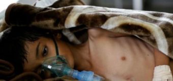У Ємені зафіксували спалах холери
