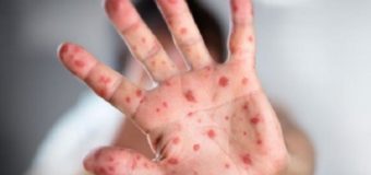 На Волині за три доби зафіксували двадцять нових випадків кору