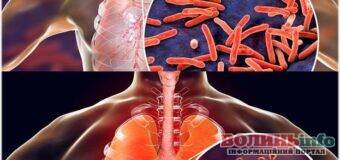 COVID-19 та туберкульоз: як не сплутати хвороби розповіли у МОЗ