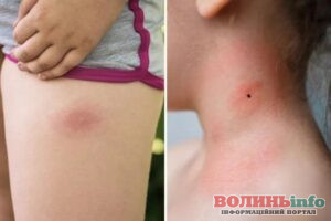 На Волині через укуси кліщів до медиків звернулися вже 277 людей, серед них — майже 100 дітей
